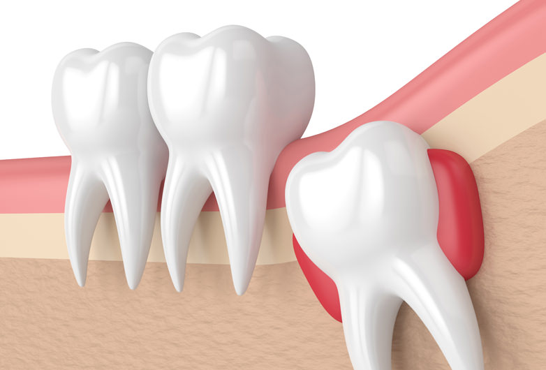 親知らずの抜歯について