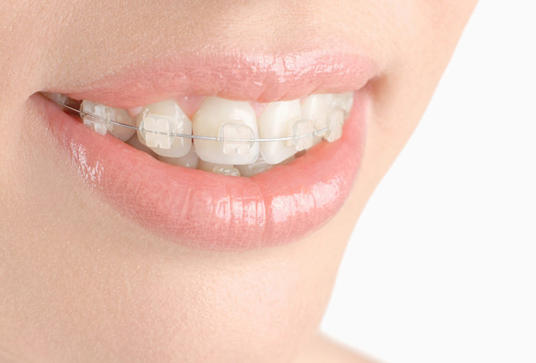 目立ちにくいワイヤー矯正